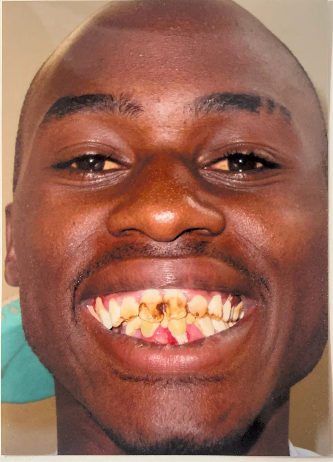 A patient before receiving free dental care from the Smiles Bring Hope team